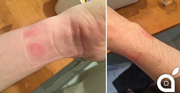apple-watch-causes-skin-rashes-for-some-users_01