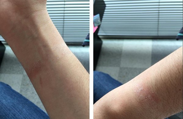 apple-watch-causes-skin-rashes-for-some-users_02