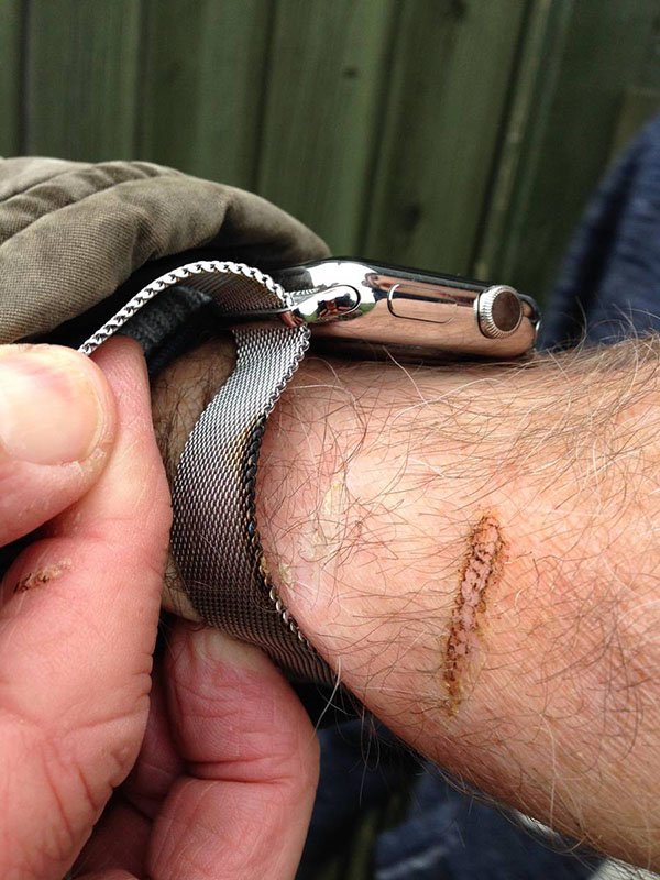 apple-watch-burns-someone_01