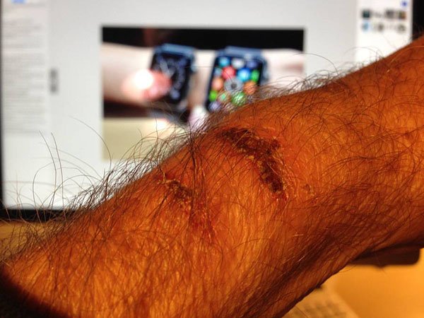 apple-watch-burns-someone_02